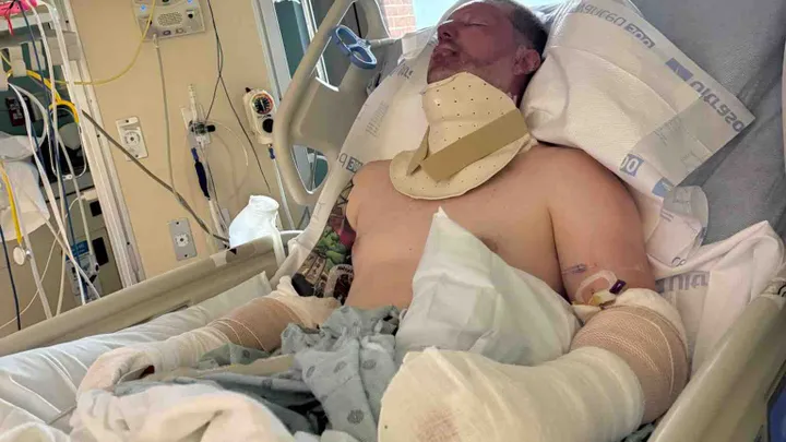 Worker Faces Long Recovery After Explosion At Baltimore Water Treatment Plant